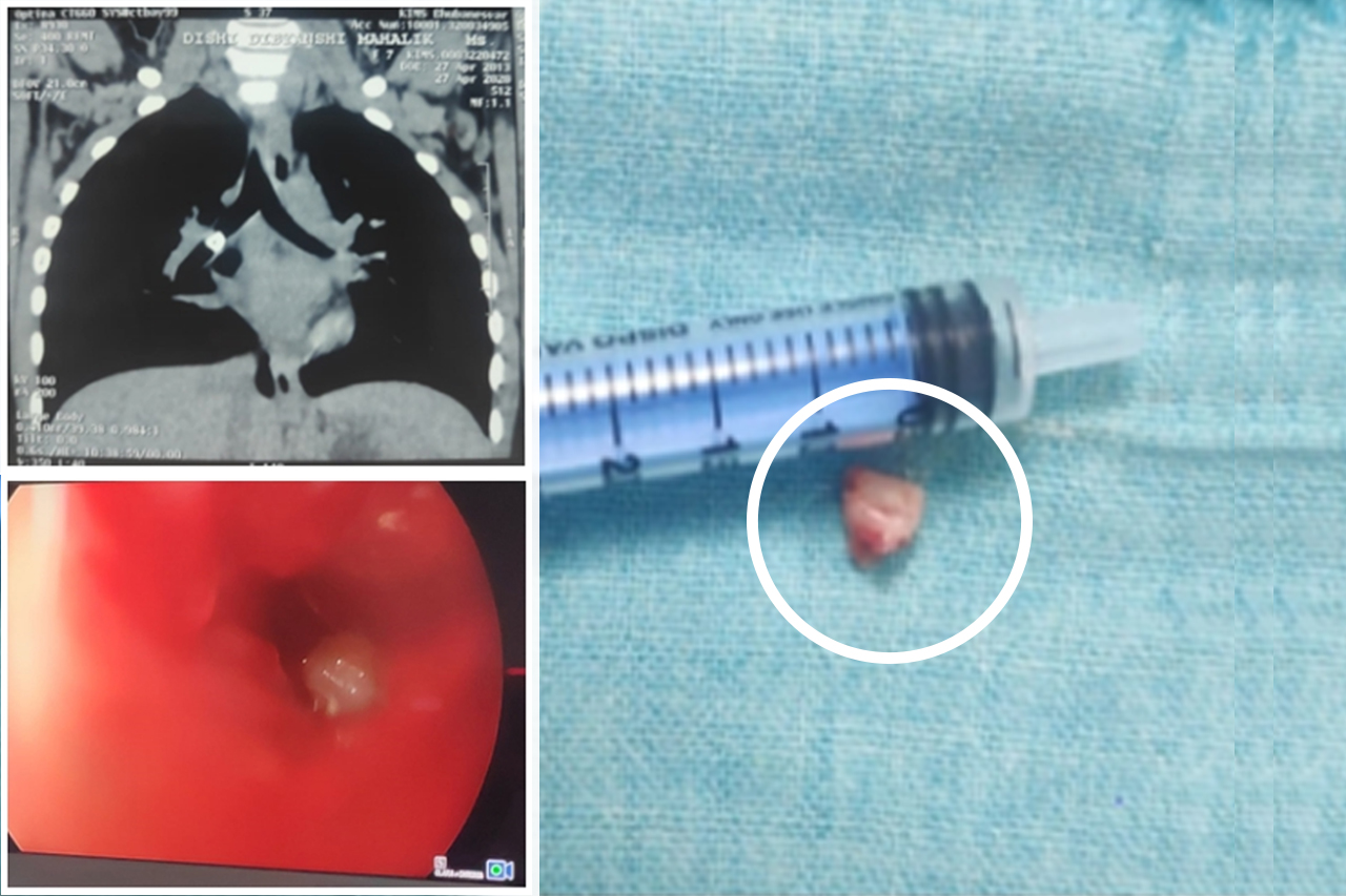 Milk Tooth Removed from Airway
