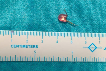 KIMS Doctors Extracts Razor-Sharp Toy from 10-Month Old Baby’s Airway